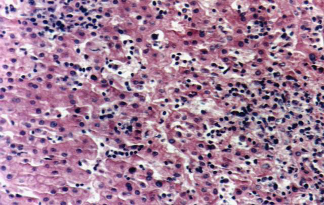 Fig.11: Infiltración hepática. H-E - <div style=